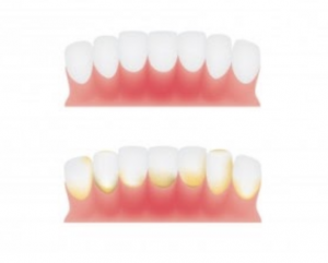 Differentiating Between Plaque and Tartar