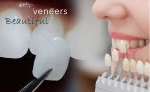 beautiful veneers