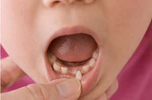 child with loose tooth