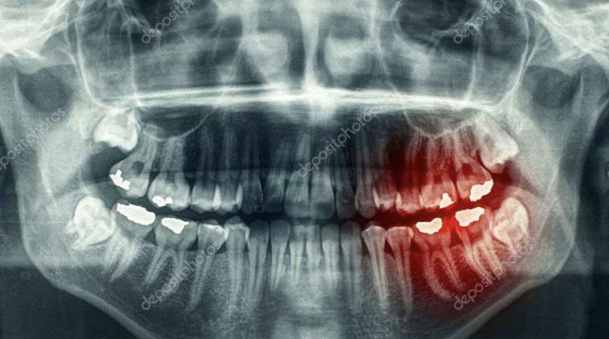 do-root-canals-cause-health-problems