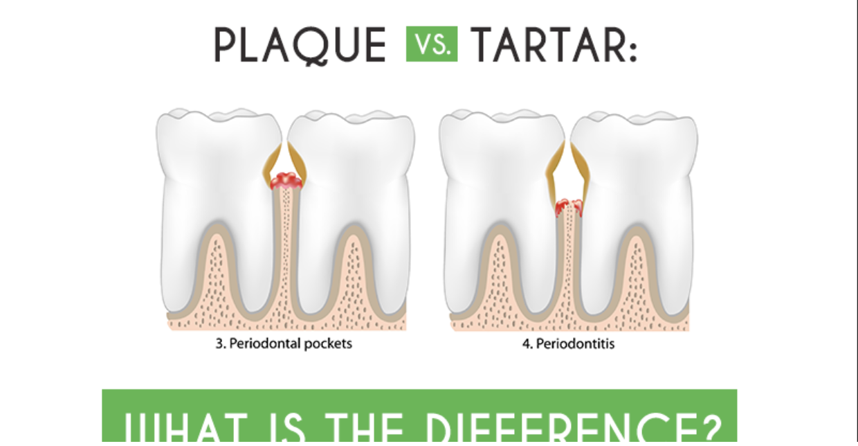 Differentiating Between Plaque and Tartar