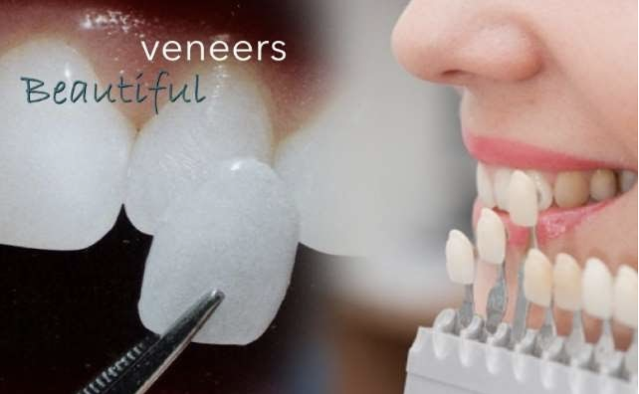 Cheaper Alternatives to Dental Veneers