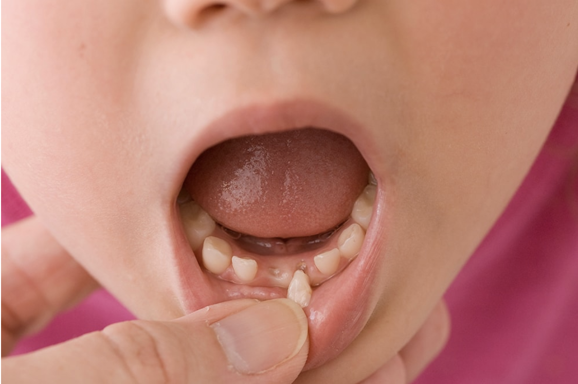 What Does It Mean If Your Adult Tooth Is Wobbly