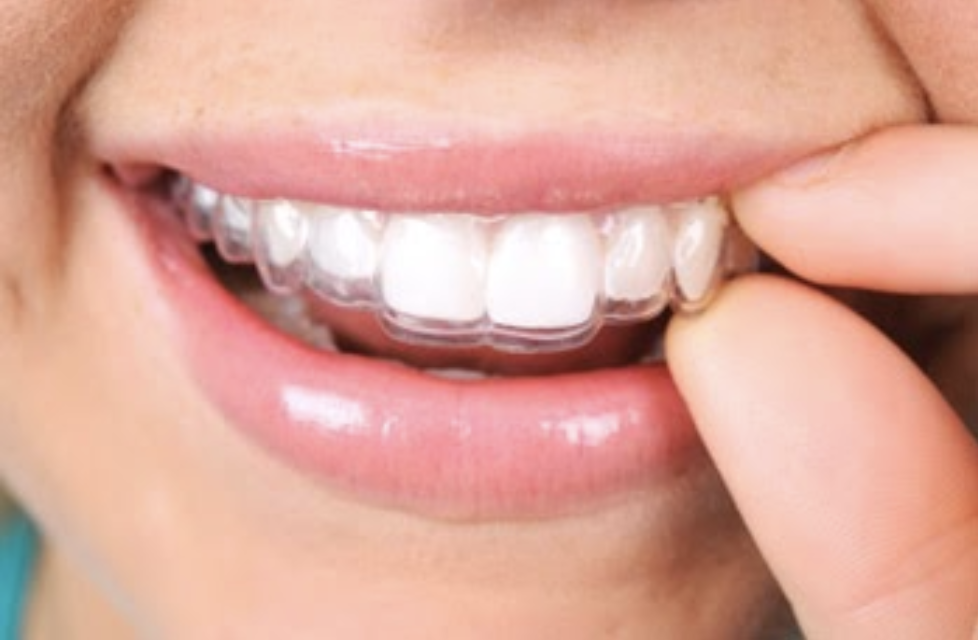 Lingual Braces vs Invisalign