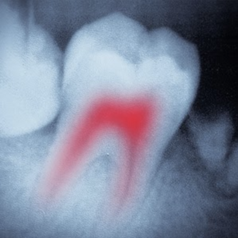 Is a Crown Necessary After a Root Canal?