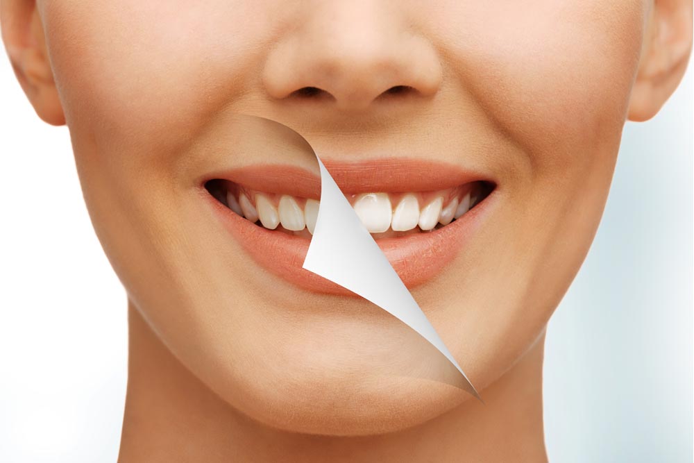 Top 5 Reasons For Teeth Whitening